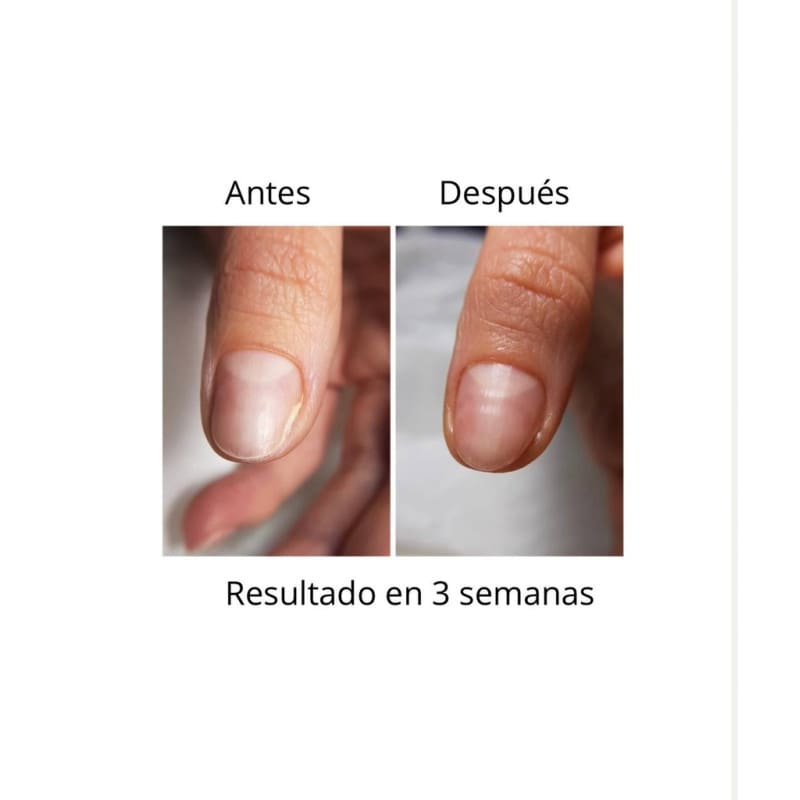 ONISTOP , aceite regenerador para uñas con onicolisis, 8 ml, evita las uñas despegadas. - Imagen 4