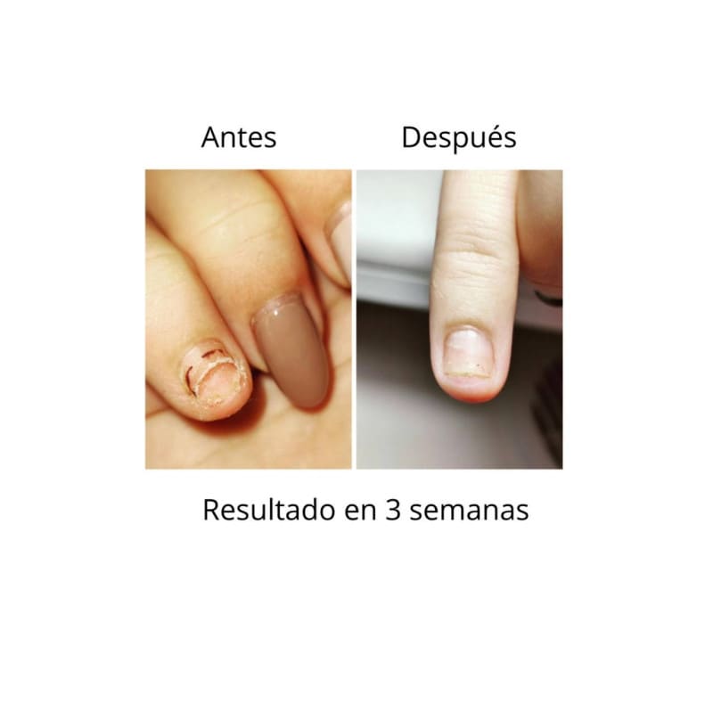ONISTOP , aceite regenerador para uñas con onicolisis, 8 ml, evita las uñas despegadas. - Imagen 2