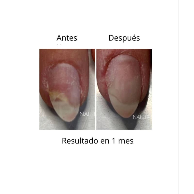 ONISTOP , aceite regenerador para uñas con onicolisis, 8 ml, evita las uñas despegadas. - Imagen 3